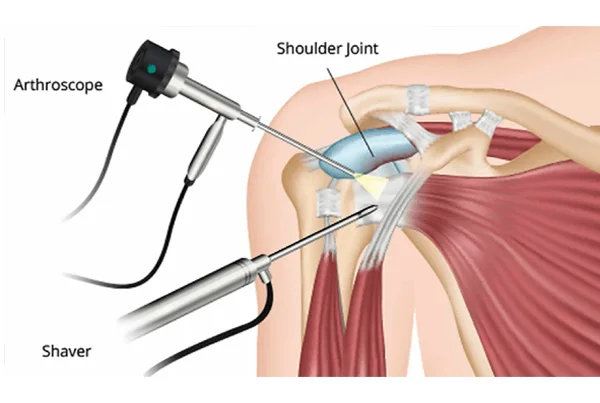 Arthroscopy